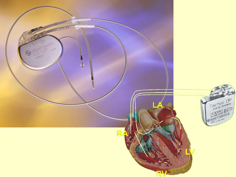 心脏起搏器图片_心脏起搏器的图片形状_心脏起搏器组成图片