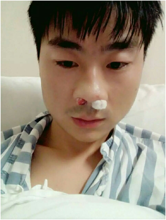 鼻炎微创手术会复发吗_鼻炎微创手术后遗症_鼻炎做完微创手术后遗症