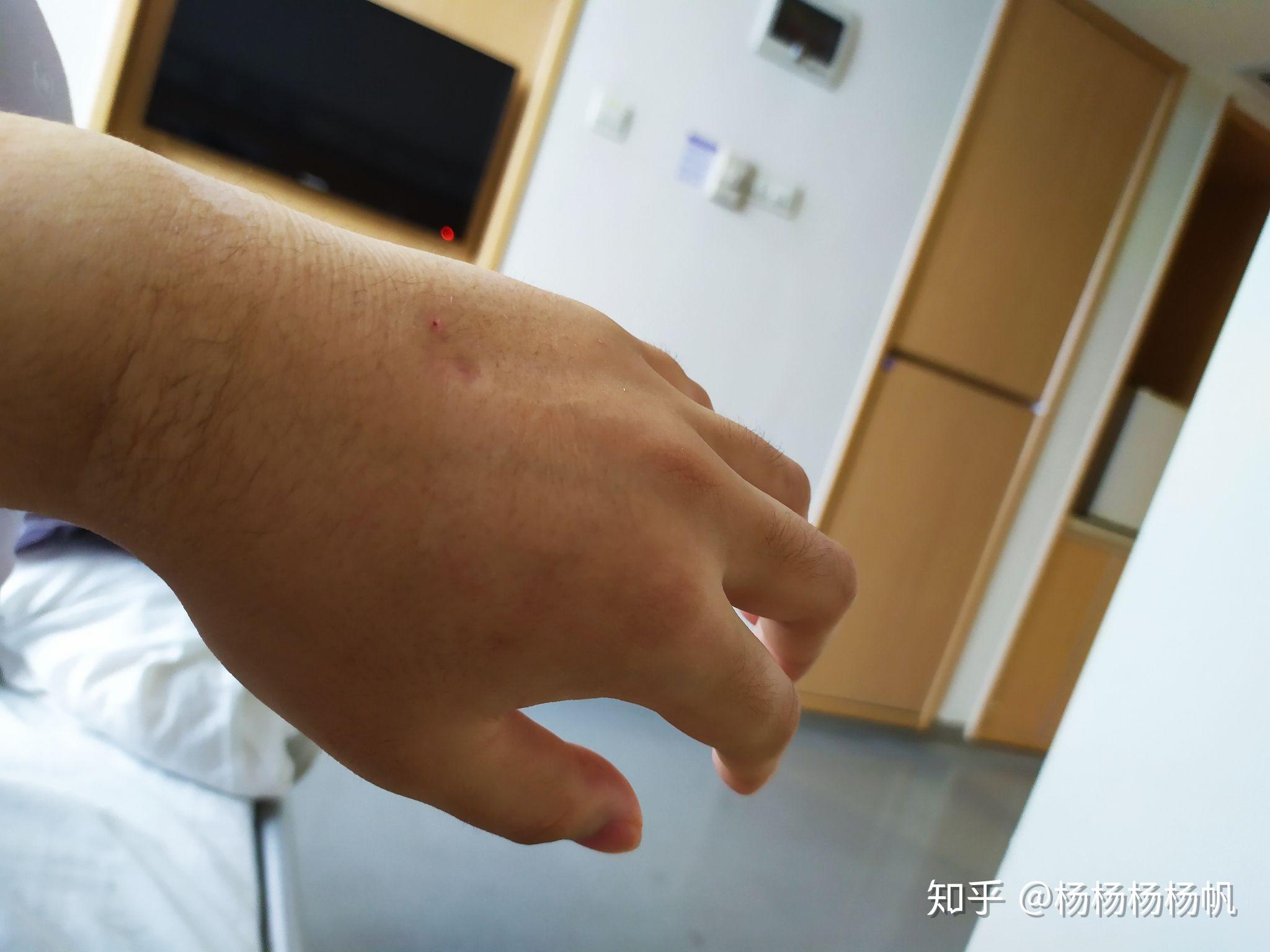 鼻炎微创手术会复发吗_鼻炎做完微创手术后遗症_鼻炎微创手术后遗症